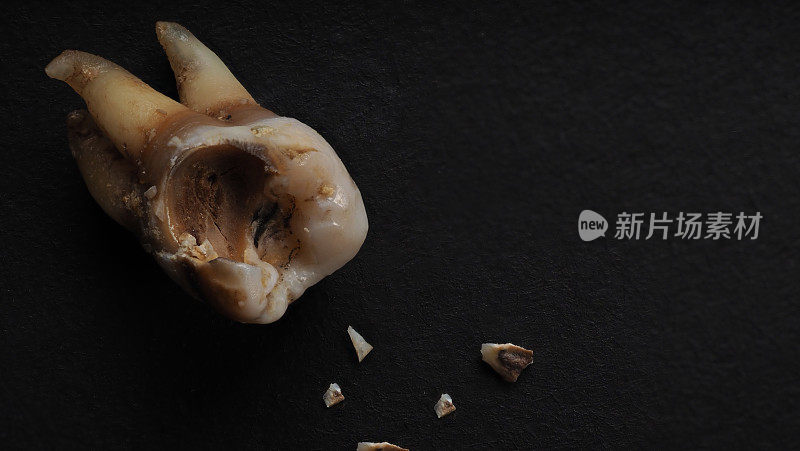 黑色背景上有蛀牙。牙科医生拔牙后的蛀牙至牙根的微距照片。真正的牙齿解剖，由于缺乏护理。黑纸上龋齿纹理的俯视图。牙科保健。
