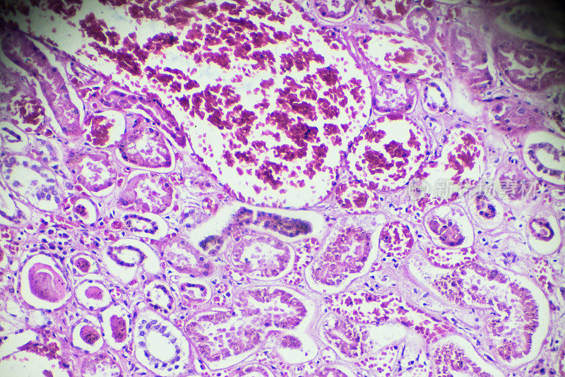 显微镜下急性肾炎活检标本