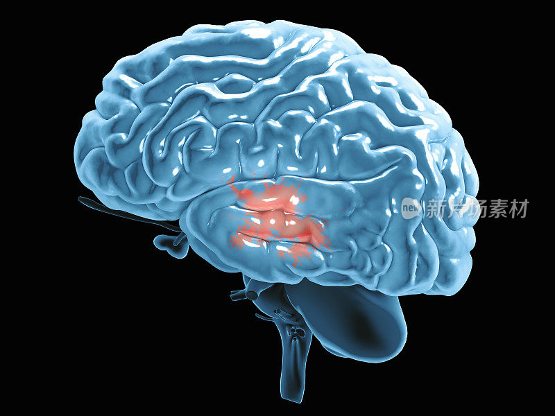从侧面看大脑的一部分。退化性疾病，帕金森，突触，神经元，老年痴呆症