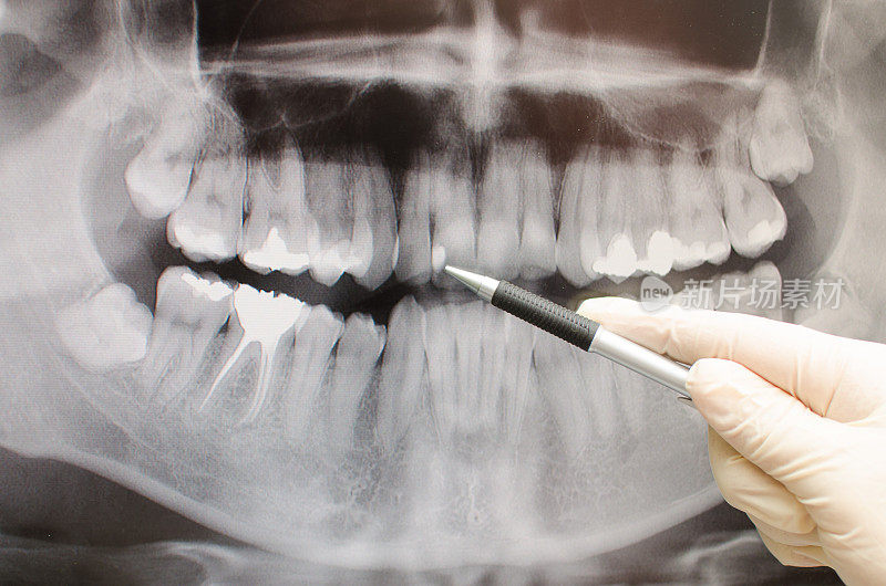 牙科医生在牙科x光图像上显示了一些东西
