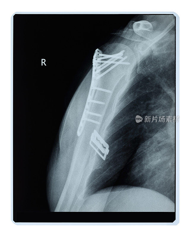 术后骨折肩部x光片