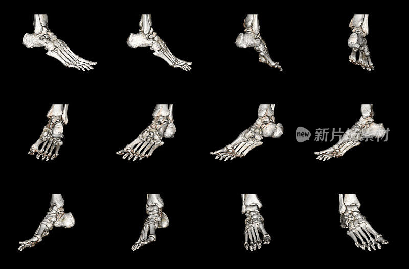 脚的CAT扫描图像