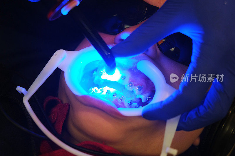 牙科医生的紫外线