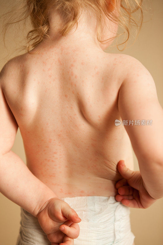 小女孩因对抗生素过敏而起疹子
