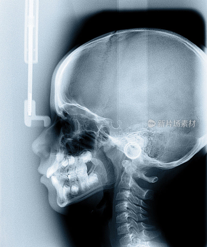 人类颅骨横向x光片