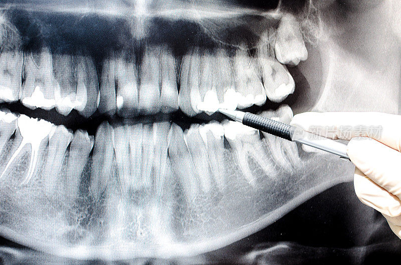 牙科医生在牙科x光图像上显示了一些东西
