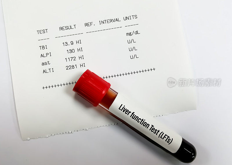 肝功能检测包括ALT、AST、ALP、总胆红素(总胆红素)。