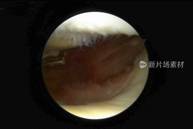 患有骨关节炎的人右膝髌股腔室的关节镜观察
