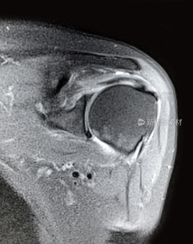 肩膀MRI图像