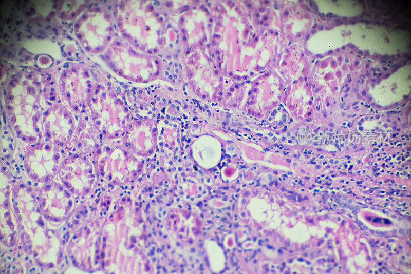 光镜下慢性肾盂肾炎活检