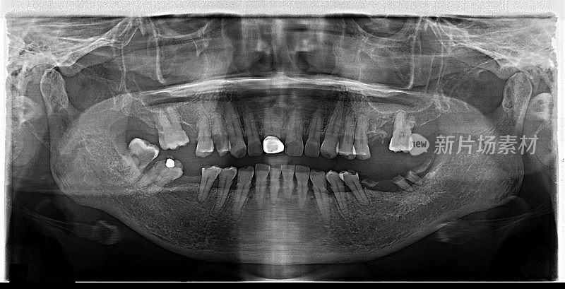 全景牙科x光牙齿图像