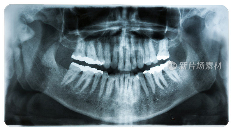 口腔x光片