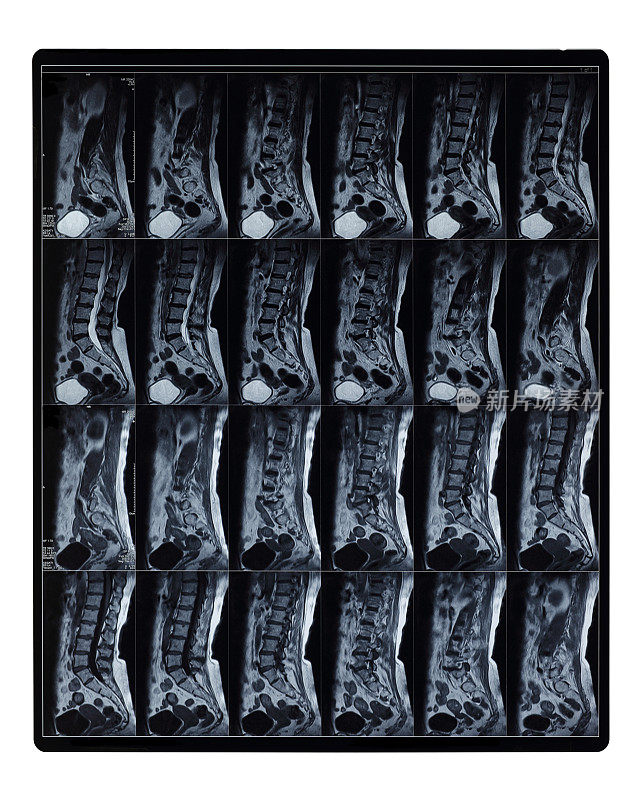 腰椎MRI扫描