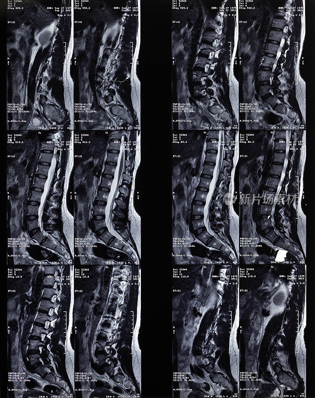 脊柱断层摄影胶片侧视图