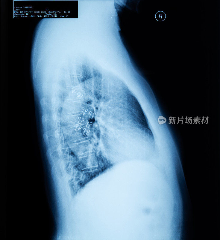 人体胸腔侧x线影像