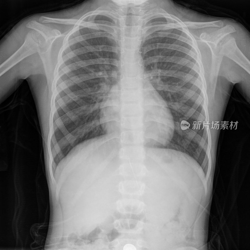 人体胸部x光图像