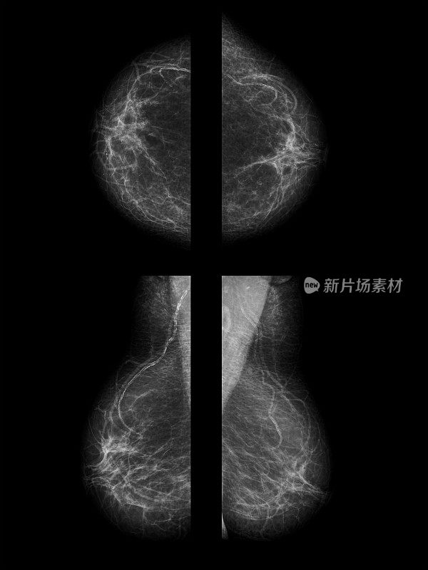 乳房x光检查