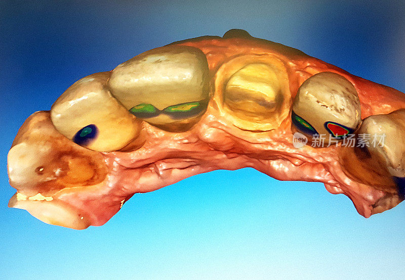 计算机生成的牙齿三维模型，用于设计牙冠
