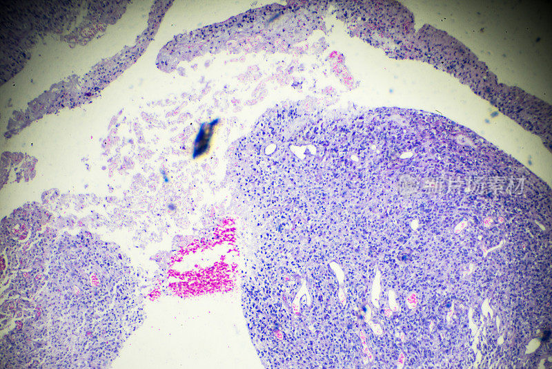 显微镜下观察睾丸生殖细胞瘤