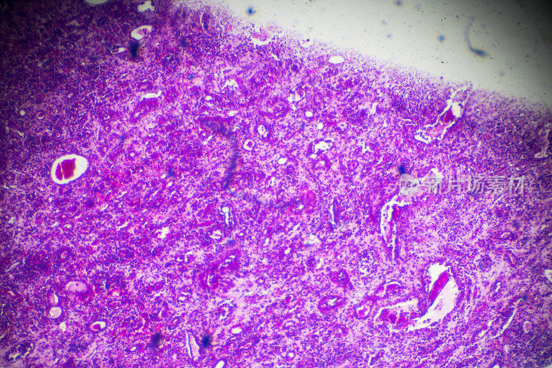 显微镜下硬化性肾小球肾炎活检标本