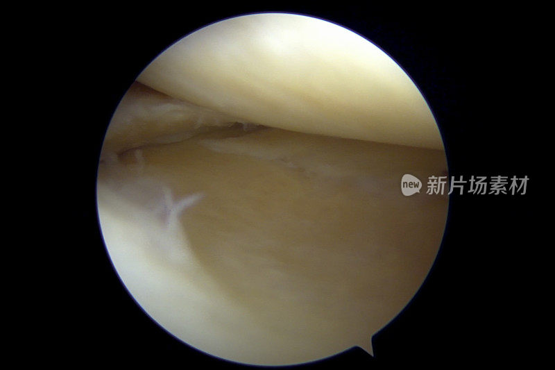 右膝内侧半月板后部皮瓣撕裂的关节镜观察