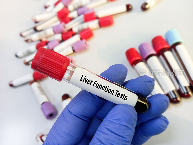 科学家持有血液样本进行肝功能测试，以诊断和监测肝脏疾病或损害。