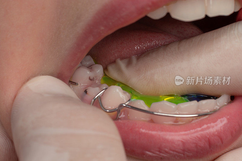 有龋齿的孩子的两颗牙齿，牙盘和龋齿。