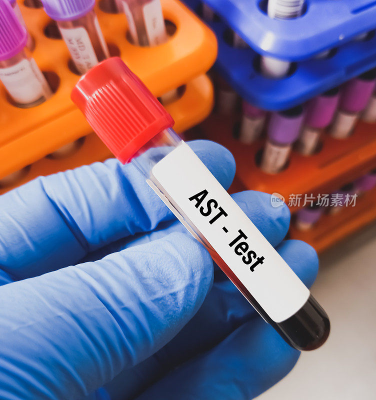 实验室用血样管进行AST(天冬氨酸转氨酶)检测，以诊断和监测肝脏疾病。