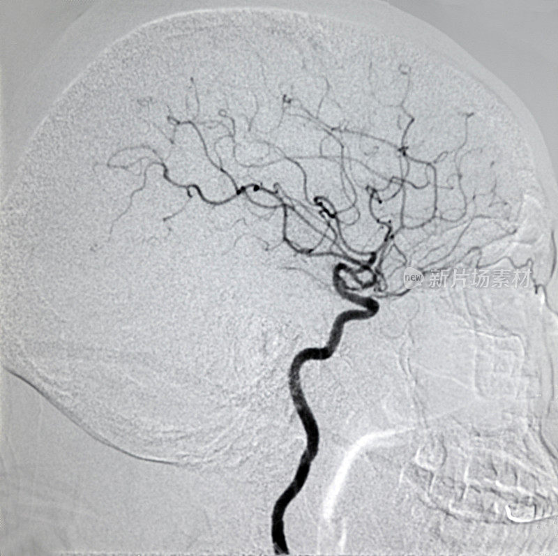 颈内动脉DSA图像