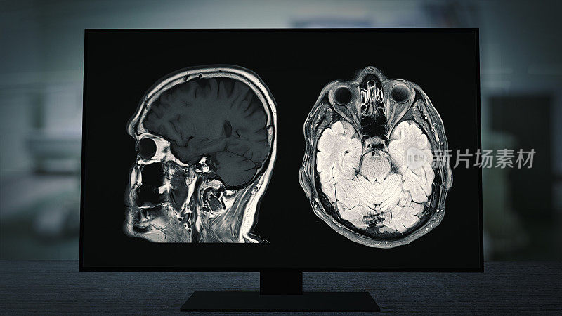 CT脑部扫描图像的磁共振成像(MRI)监视器