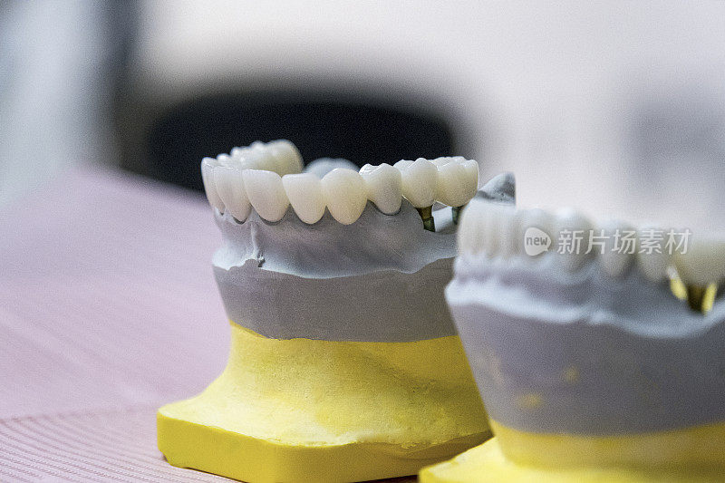 牙医种植上下牙齿