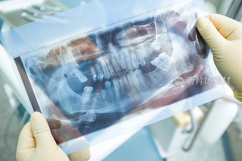 人类牙齿的x射线全景图