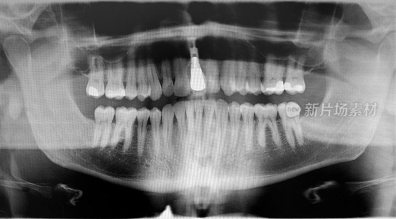 全口种植体、牙齿及填充物的数字牙科x光片