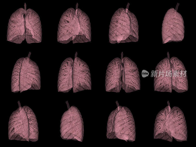 人肺三维CT扫描图像