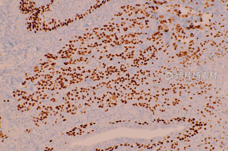 鳞状细胞癌的显微镜图像