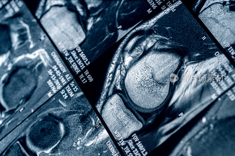 膝关节磁共振(MRI)扫描