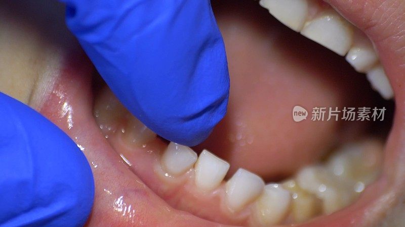 牙医戴着蓝手套检查松动的牙齿