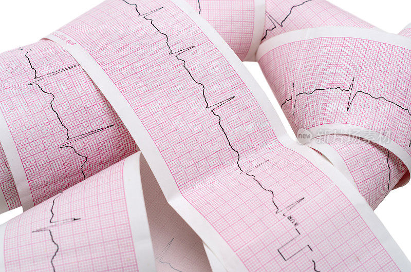 有心跳脉搏的纸心电图