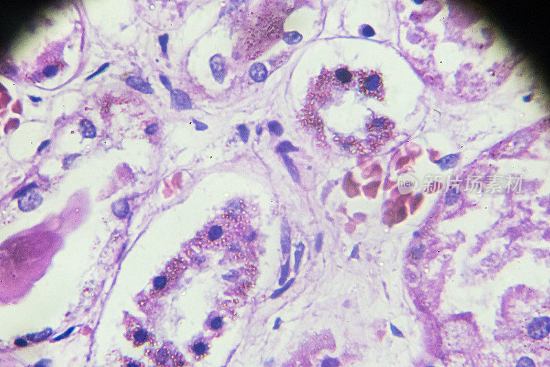 显微镜下急性肾炎活检标本