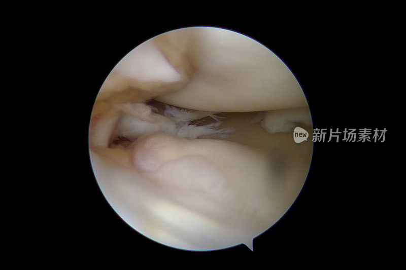 内侧半月板后部复杂退行性撕裂的人类膝关节关节镜视图