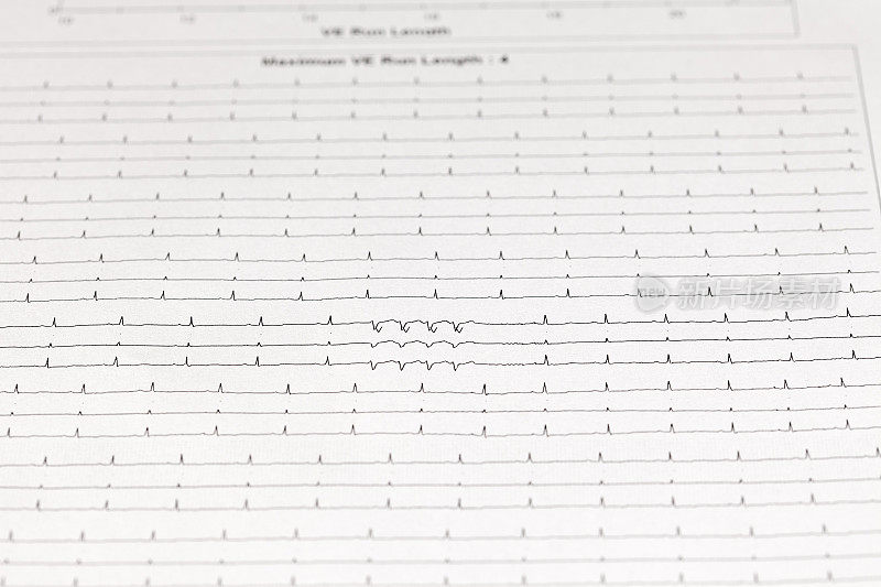 心电图(ECG)