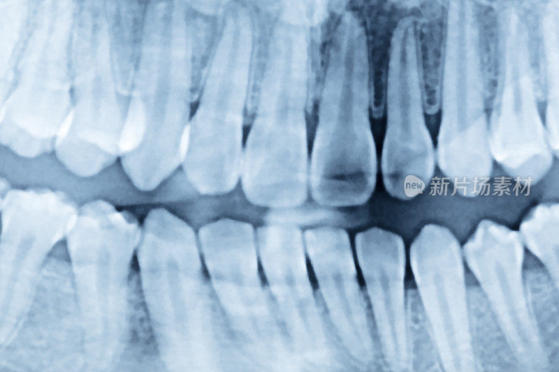 近距离拍摄牙齿x光片。