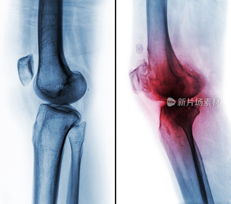 正常人膝关节(左图)与骨关节炎膝关节(右图)的比较。侧面图