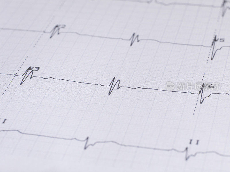 心电图(ECG)