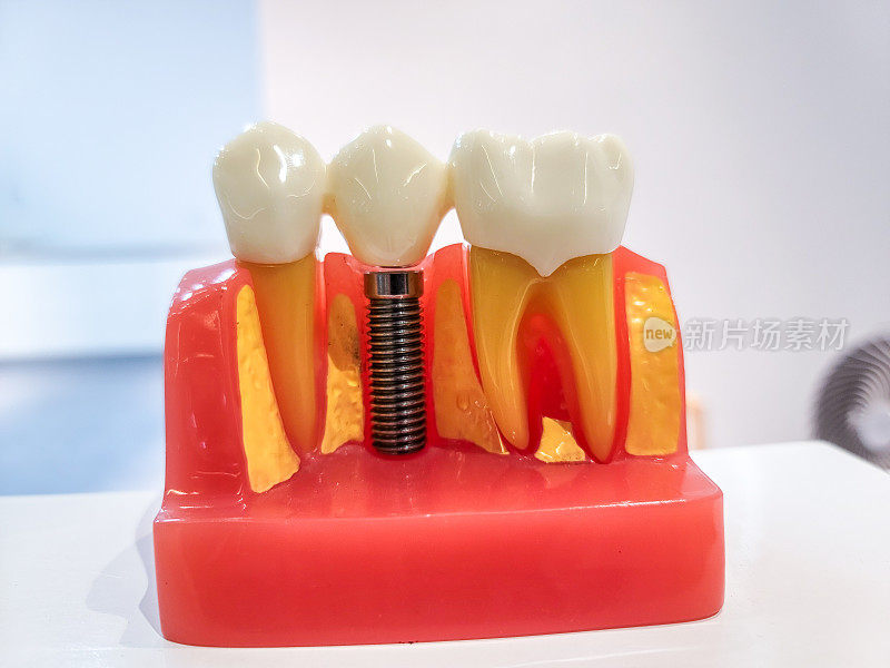 龋齿和种植牙模型