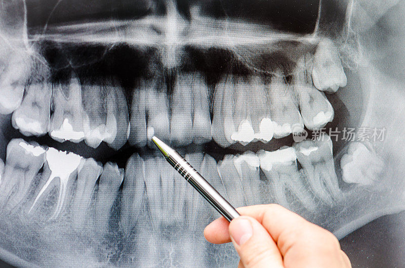 牙科医生在牙科x光图像上显示了一些东西