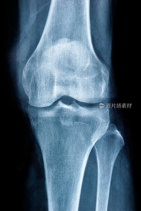 膝关节x线显示半月板骨折