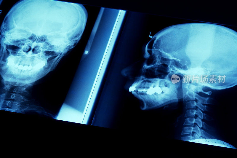 两个x光人类头骨的蓝色图像