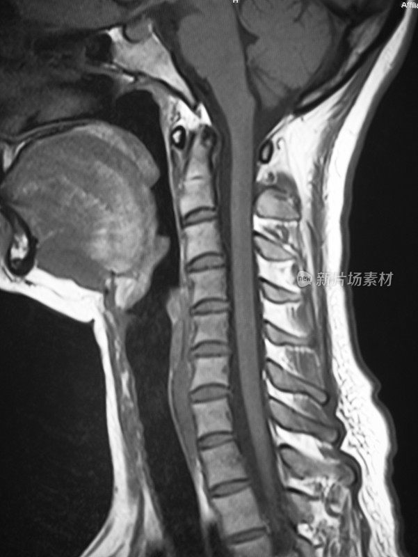 人体颈椎磁共振成像(MRI)