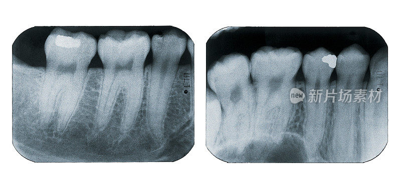 牙齿的射线照相